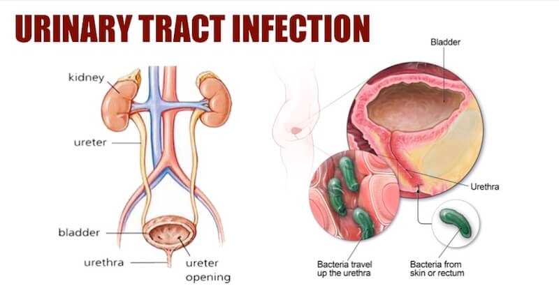urinary tract infection